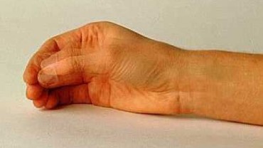 Parkinson